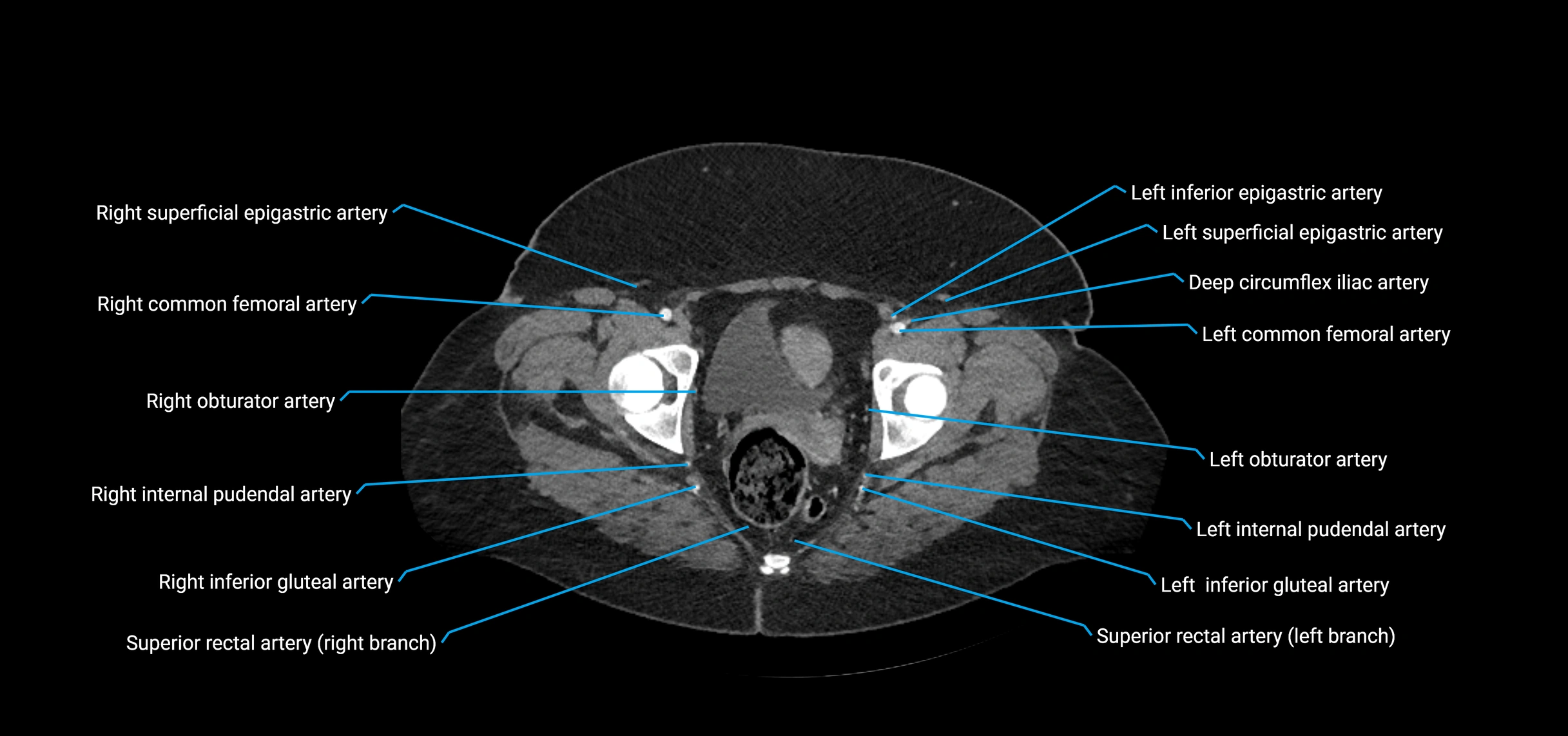 CTA abdomen axial cross sectional anatomy labelled image_239 (2).webp